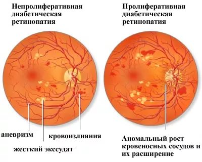 Что такое декомпенсация сахарного диабета, ее причины и последствия Что такое декомпенсация сахарного диабета, ее причины и последствия