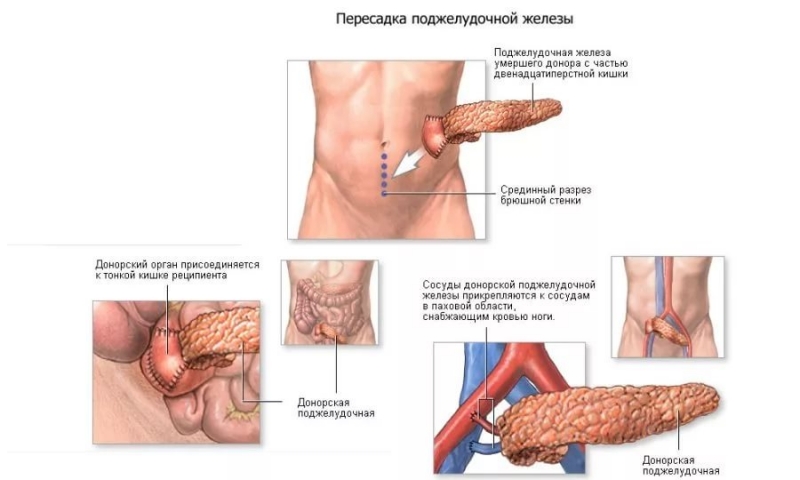Новое в лечении диабета 1 типа: основные направления терапии