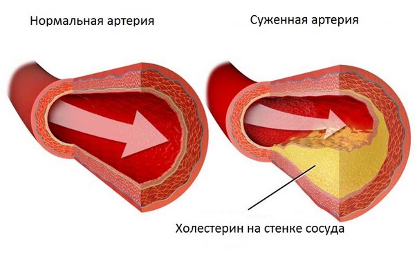 Последствия ампутации ног при сахарном диабете Последствия ампутации ног при сахарном диабете
