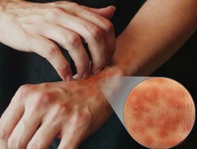 Зуд кожи при сахарном диабете у женщин: чешется в интимном месте, лечение Зуд кожи при сахарном диабете у женщин: чешется в интимном месте, лечение