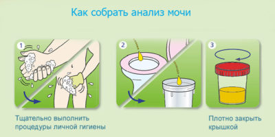 Анализ мочи на сахар: как сдавать, правила Анализ мочи на сахар: как сдавать, правила