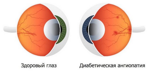 Возможные осложнения при диабете Возможные осложнения при диабете