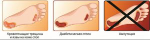 Гангрена ноги: фото, начальная стадия при сахарном диабете 1 и 2 типа Гангрена ноги: фото, начальная стадия при сахарном диабете 1 и 2 типа