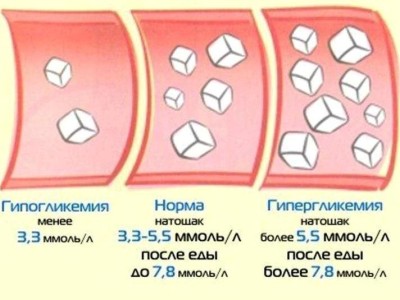 Гипогликемическая кома: симптомы, состояние, неотложная помощь Гипогликемическая кома: симптомы, состояние, неотложная помощь