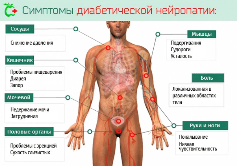 Диагностика и лечение диабетической полинейропатии Диагностика и лечение диабетической полинейропатии