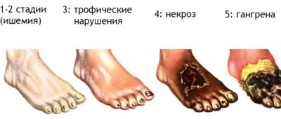 Гангрена нижних конечностей при сахарном диабете: как начинается, признаки, лечение Гангрена нижних конечностей при сахарном диабете: как начинается, признаки, лечение