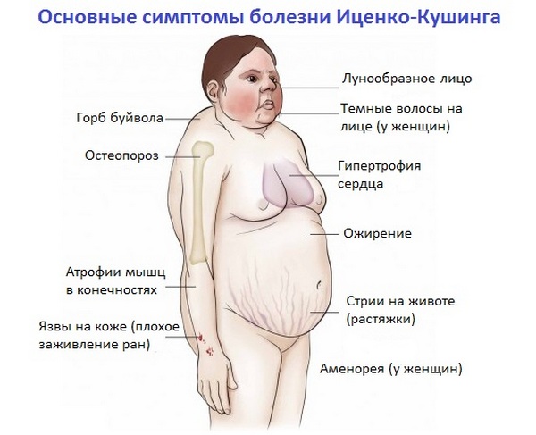 Стероидный диабет и его особенности Стероидный диабет и его особенности