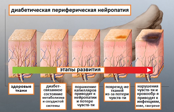 Осложнения сахарного диабета на поздней стадии