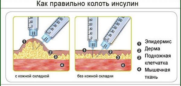Как подобрать длинный и короткий инсулин