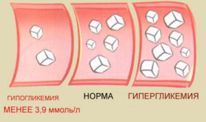 Некомпенсированный сахарный диабет что это такое