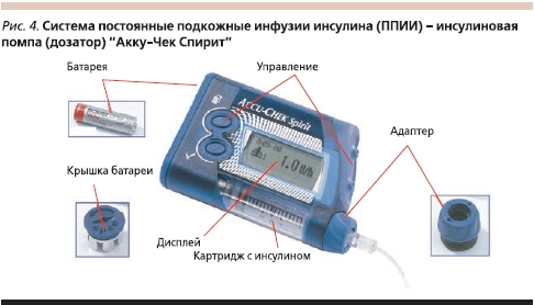 Инсулиновая помпа: что это такое, как работает и как получить ее бесплатно