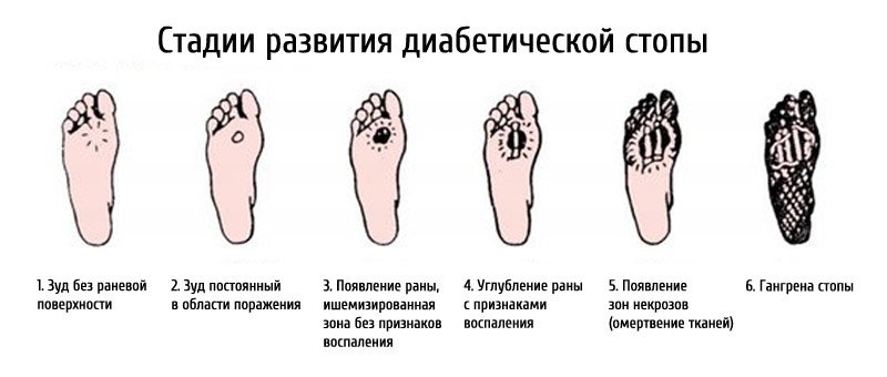Какие первые признаки и симптомы сахарного диабета у мужчин