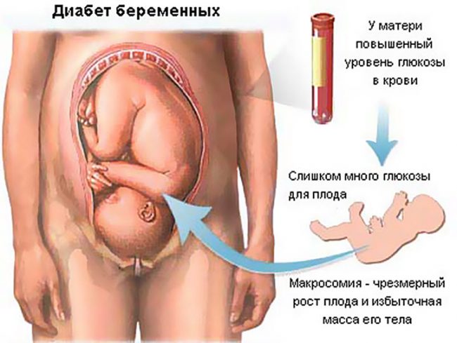 Как проходят роды при гестационном сахарном диабете? Как проходят роды при гестационном сахарном диабете?