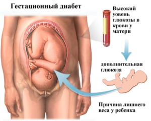 Гестационный сахарный диабет при беременности - что такое, чем опасен Гестационный сахарный диабет при беременности - что такое, чем опасен