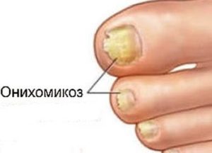 Почему почернел палец и ногти на ноге при сахарном диабете - удаление