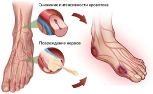 Диабетическая стопа - симптомы, как и чем лечить, профилактика синдрома