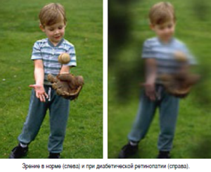 Зрение и диабет - ухудшение и потеря зрения, симптомы начала развития