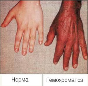 Бронзовый диабет (гемохроматоз) - симптомы, лечение, профилактика