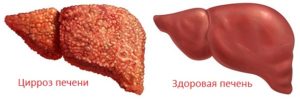 Бронзовый диабет (гемохроматоз) - симптомы, лечение, профилактика